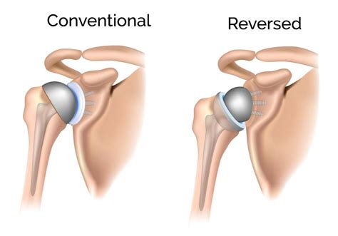 What is Right Reverse Total Shoulder Arthroplasty - shoulder clinic ...