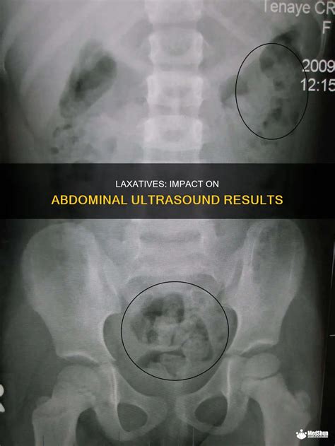 Laxatives: Impact On Abdominal Ultrasound Results | MedShun