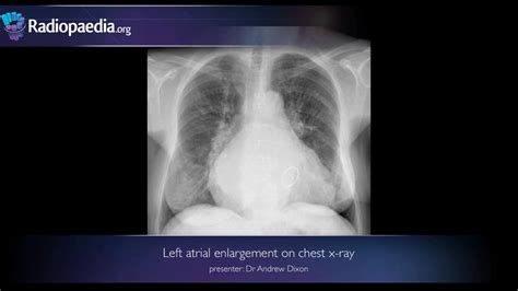 Left atrial enlargement on chest x-ray - radiology video tutorial - YouTube