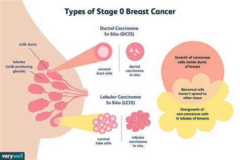 Breast Cancer: Types, Symptoms, Diagnosis, Treatment - PMCC Denver ...