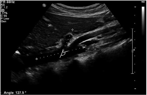 Real-time ultrasound: Key factor in identifying celiac artery compression syndrome