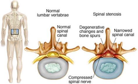 Cervical Stenosis - Symptoms, Surgery, ICD 10, What is, Causes, Rx