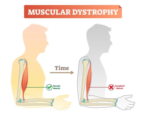 Muscular Dystrophy: What Causes This Disabling Condition? - University Health News