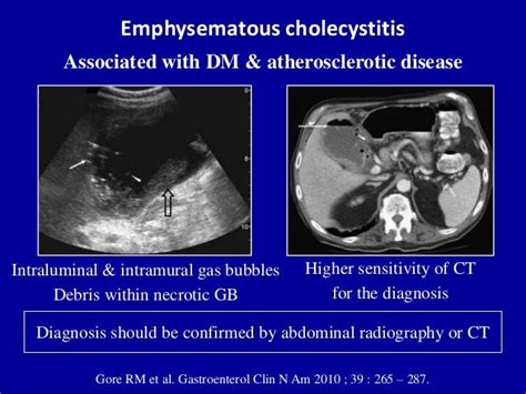 Ultrasound of acute & chronic cholecystitis