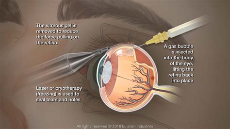 Retinal Detachment Surgery