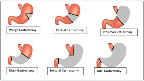 Gastrectomy - Canadian Gastric Cancer Association