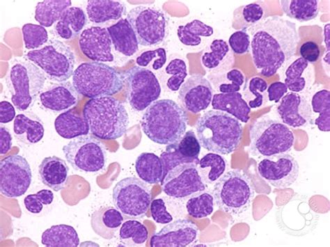 Pathology Outlines - Atypical chronic myeloid leukemia (aCML)