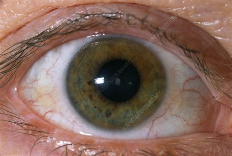 Congenital cataract - Stock Image - M155/0491 - Science Photo Library