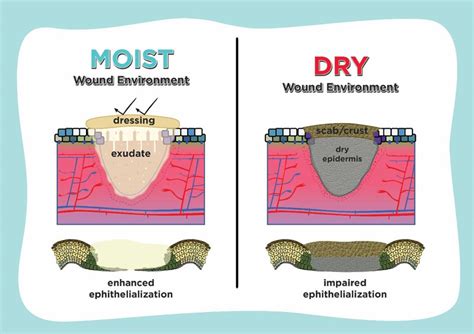 Lessons From Epithelialization: The Reason Behind Moist Wound Environment