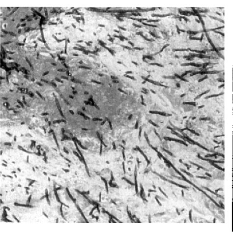 Figure 1 from Cutaneous Presentation of Fusarium Solani Infection in a Bone Marrow Transplant ...