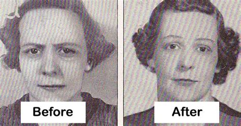 15 Lobotomy Patients Before And After Their Procedure