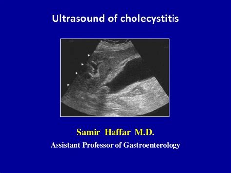 Ultrasound of acute & chronic cholecystitis