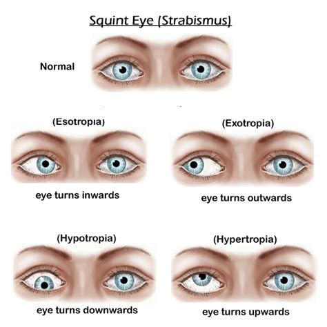 SQUINT and Deviation Of Eyes (Simple Facts) - Eye Surgeon