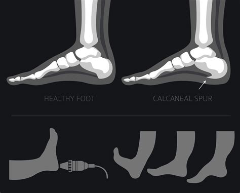 Metatarsal Bone Spur Treatment