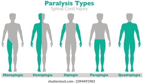 Paraplegia Vs Paraparesis