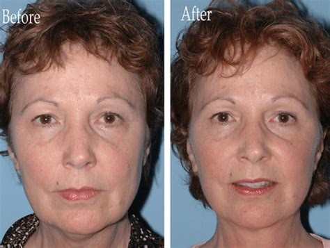 Facelift Surgery - MU Health Care