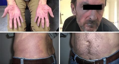 Pre‐treatment images showing marked acrocyanosis and livedo reticularis ...