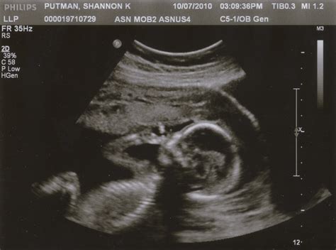 18 Weeks Ultrasound | ... and it's a girl! | Shannon | Flickr