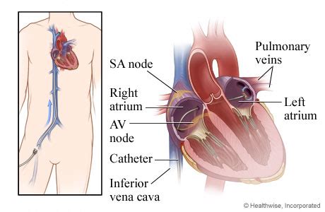 Catheter Ablation for Atrial Fibrillation | HealthLink BC