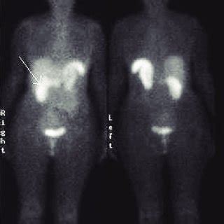 Pathology specimen showing pancreatic islet cell tumor. | Download ...