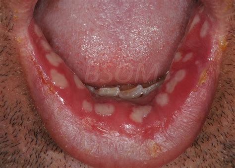 Sudden Onset Painful Mouth Ulcers – Herpes - British & Irish Society for Oral Medicine