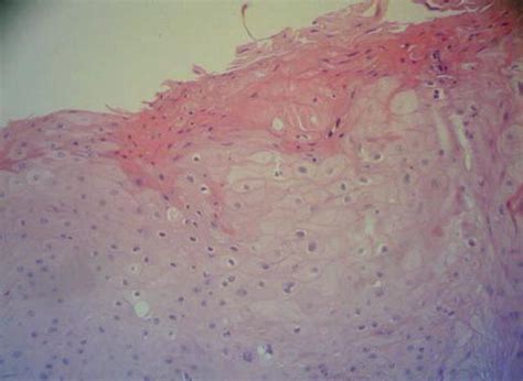 Oral Chronic Hyperplastic Candidosis | Pocket Dentistry