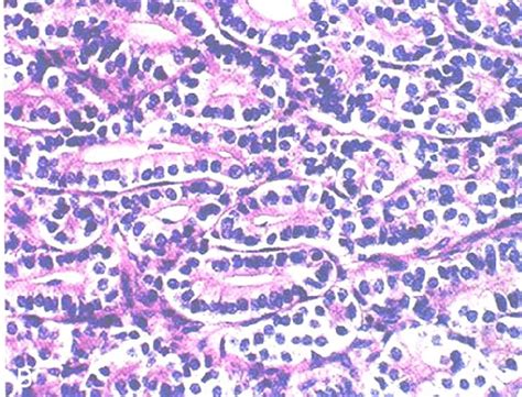 Pathology of Sertoli-Leydig cell tumor. There are solid tumors with ...