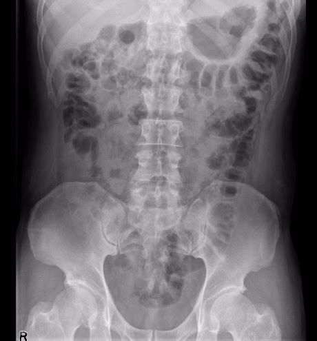 Plain Abdominal Radiograph