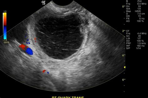 Ovarian cyst - wikidoc