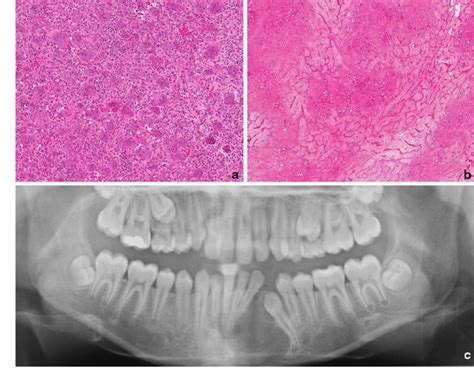 Central giant cell granuloma. a Accumulations of multinucleated giant... | Download Scientific ...