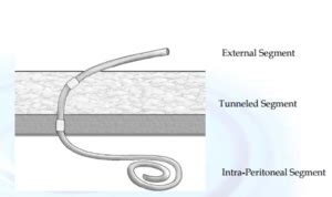 Tenckhoff Catheter Insertion by a Nephrologist - Renal Fellow Network