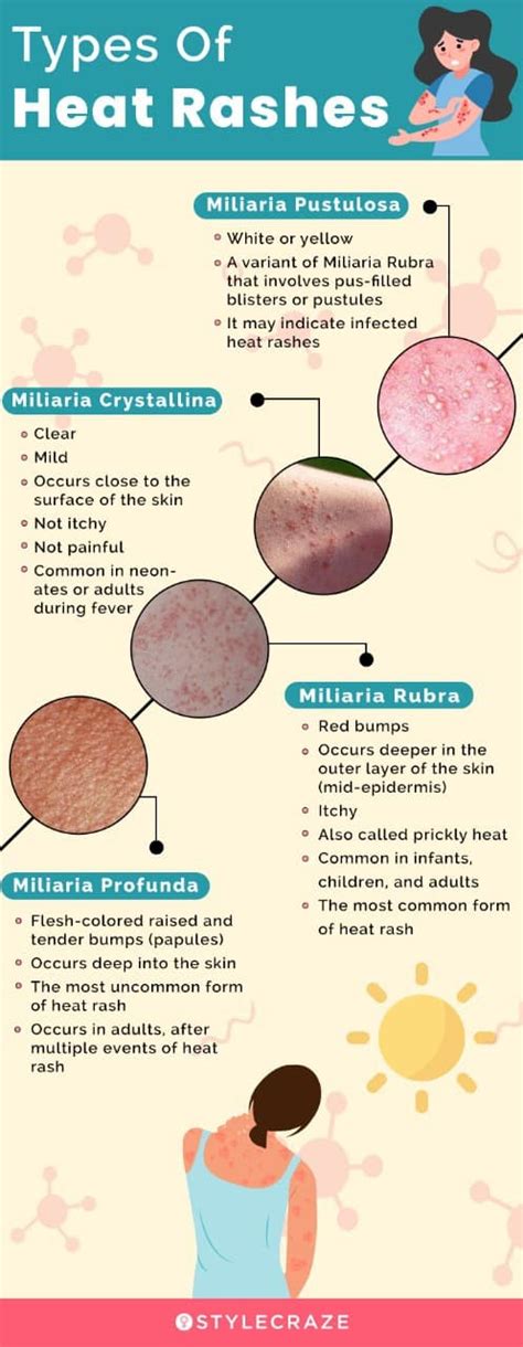 Heat Rash Prickly Heat Types Causes Symptoms Diagnosis Off The Best | The Best Porn Website