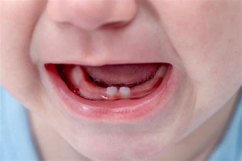 Eruption of Your Child’s Teeth - Desert Dental Spa