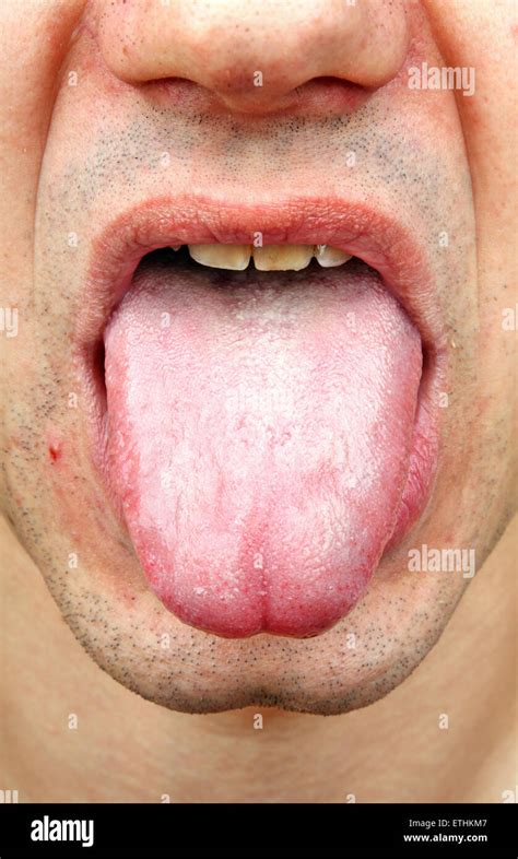 Anemia tongue hi-res stock photography and images - Alamy