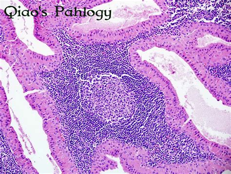 Qiao's Pathology: Warthin's Tumor of Parotid Gland - a photo on Flickriver