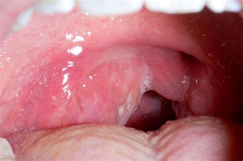 Tonsillar Cellulitis and Tonsillar Abscess - Tonsillar Cellulitis and Tonsillar Abscess - MSD ...