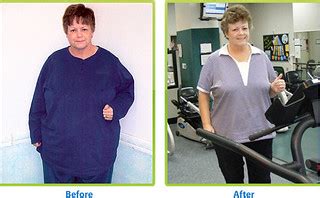 Before and after weight loss surgery | Licensed under a crea… | Flickr