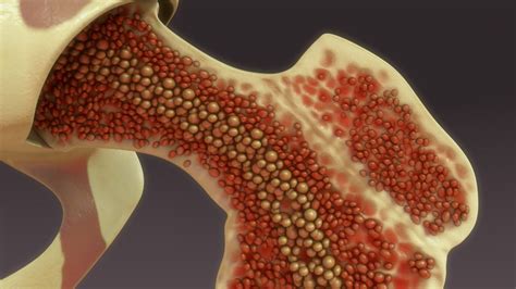 Understanding Bone Marrow Biopsy Pain and Discomfort - CBDTC