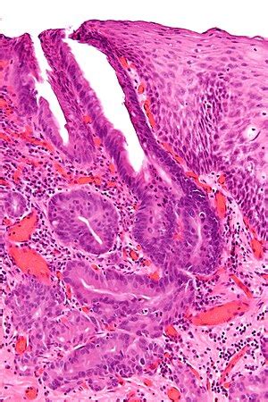 Esophageal adenocarcinoma - Libre Pathology