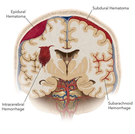 Top 18 Is A Brain Hemorrhage Painful Update