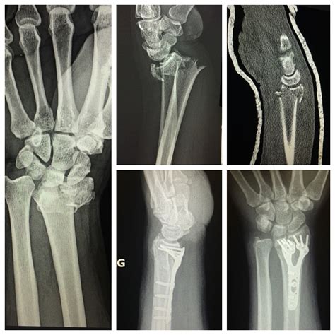 Wrist Fracture Treatment in Raleigh - John Erickson, MD