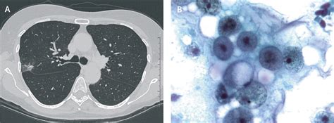 Endogenous lipoid pneumonia associated with primary sclerosing ...