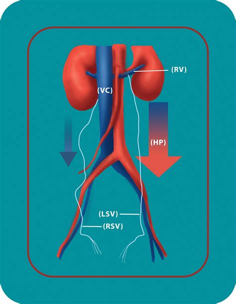 Causes & Treament of Varicocele | Georgiadis Urology