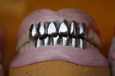 Metal Teeth Dental Denture - Free photo on Pixabay