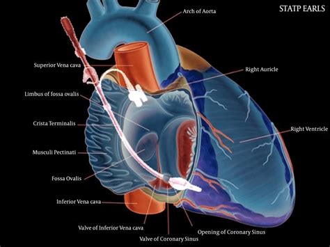 Anatomical location of coronary sinus for blood sampling | Download ...