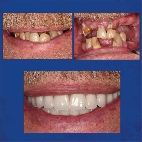 Dentures Wellington FL, New Teeth, Complete & Partial Dentures