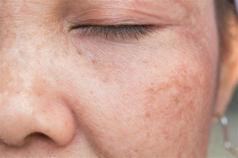 What are age spots and what causes them? | by Bold.Cosmetics | Medium