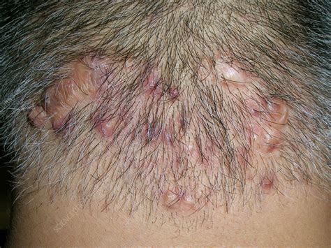 Acne keloidalis nuchae - Stock Image - C056/0867 - Science Photo Library