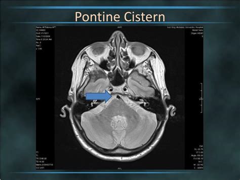 PPT - Brain Cisterns PowerPoint Presentation - ID:2263744