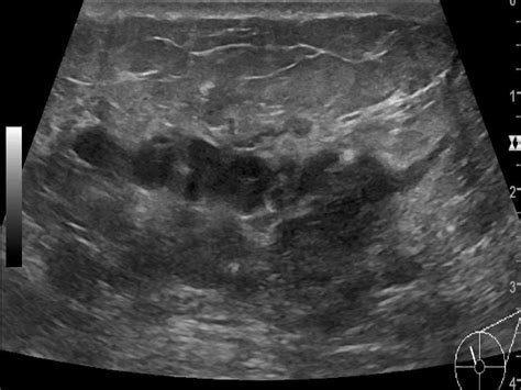 Breast lumps ultrasound - wikidoc